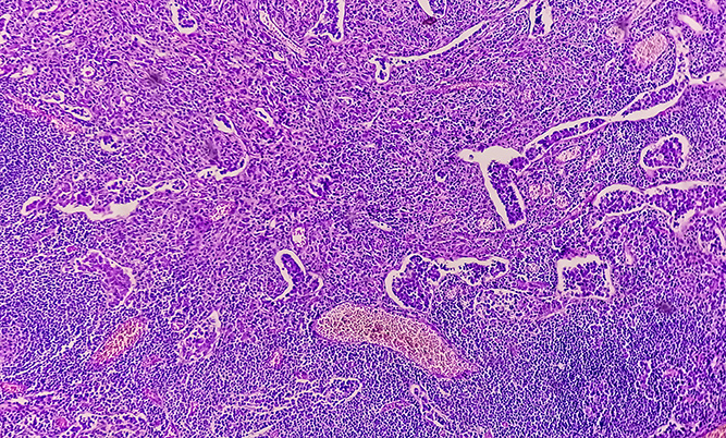 CLDN18.2-Positive Gastric and GEJ Cancers